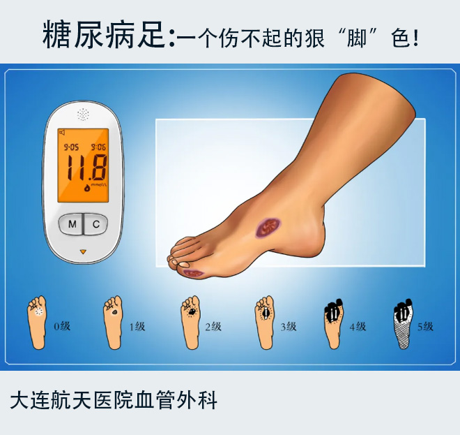 糖尿病足的早期症状