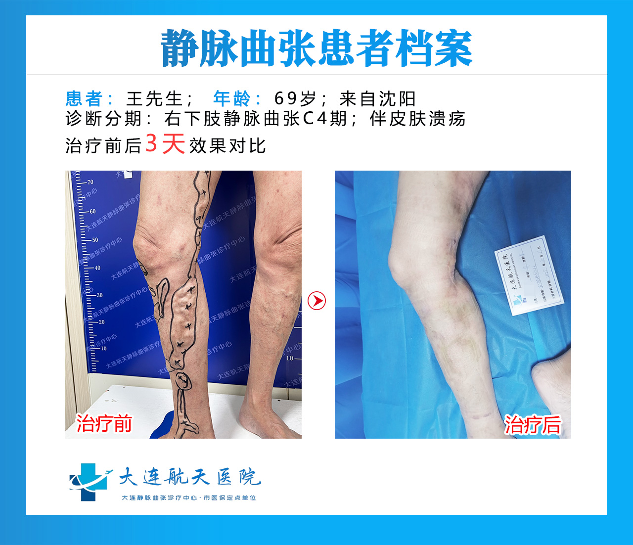 为什么女性更容易得静脉曲张？