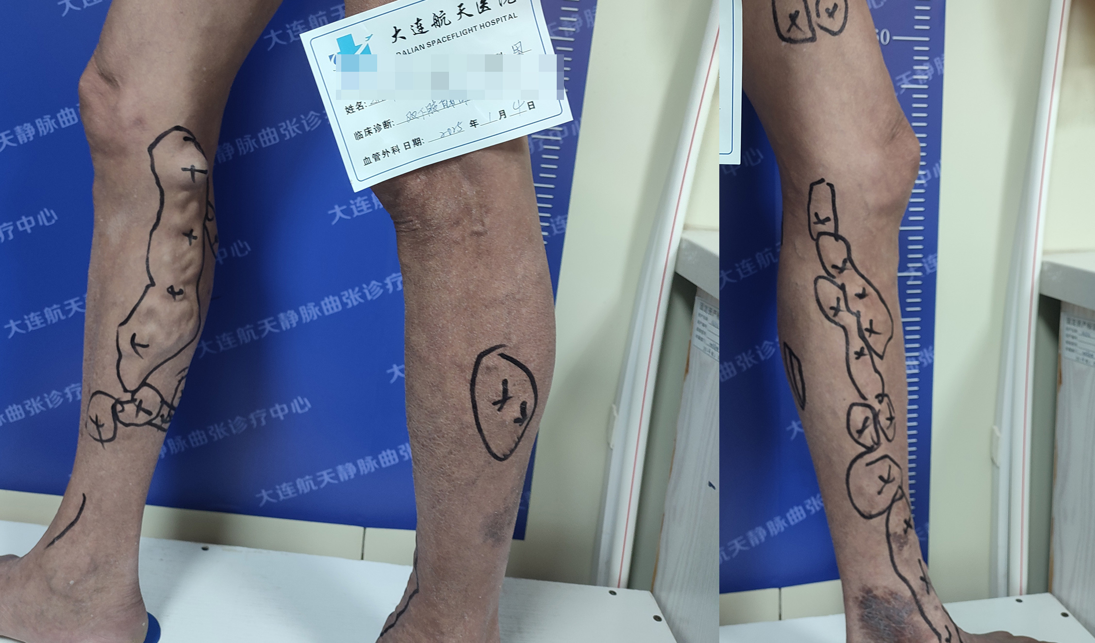 下肢静脉曲张的临床表现