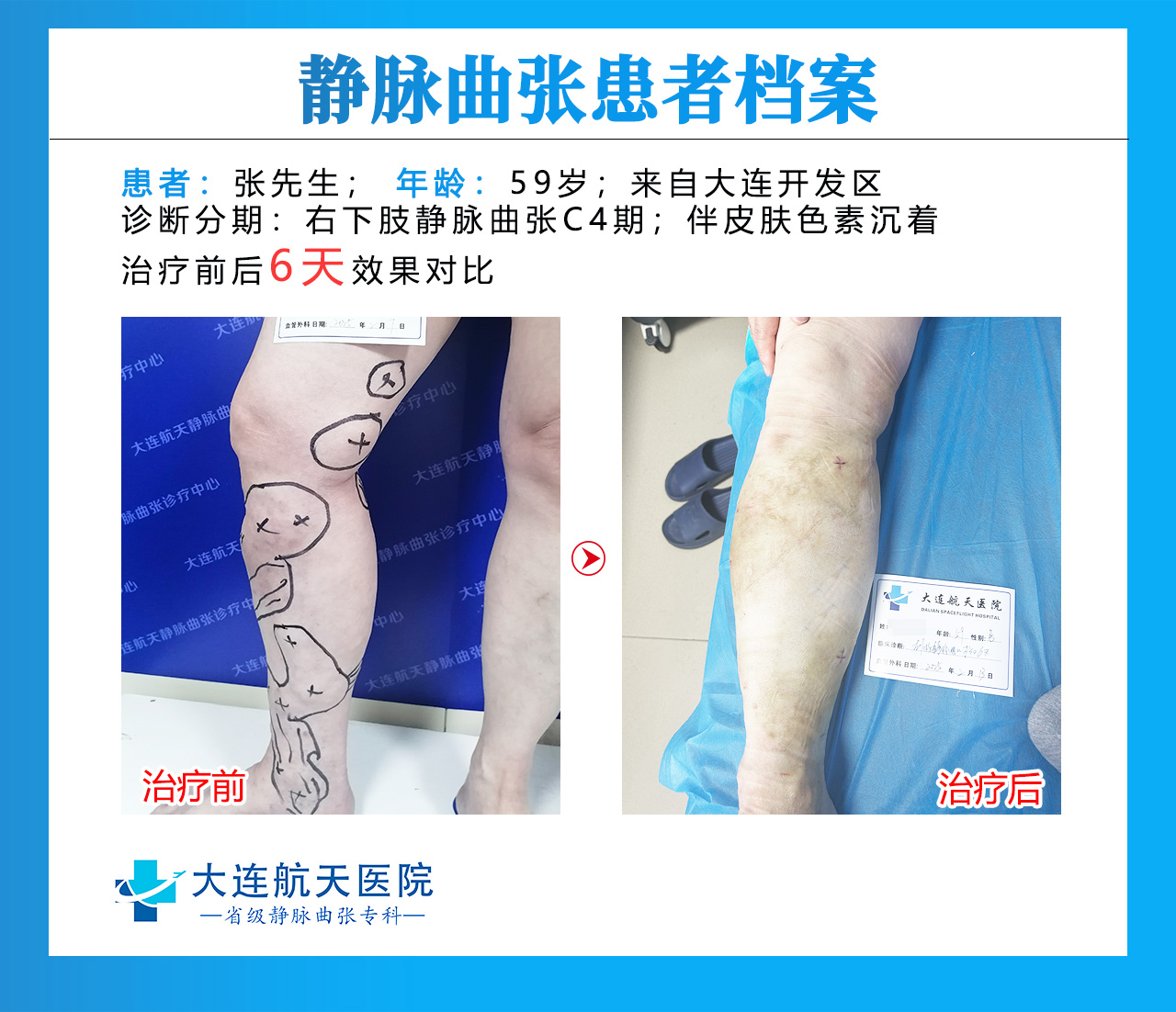如何治疗下肢静脉曲张？