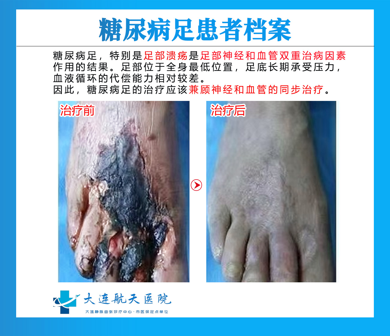 腿部静脉曲张怎么治疗不复发？