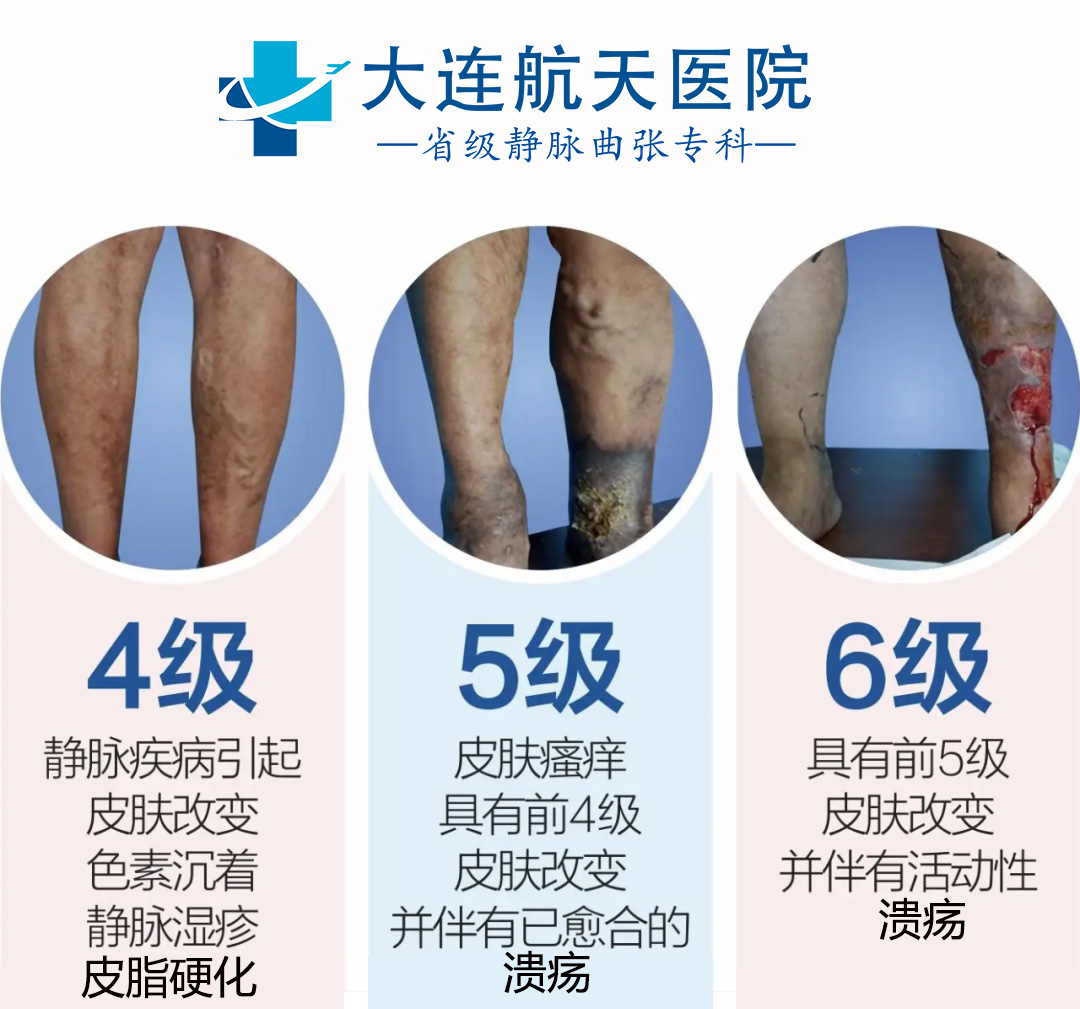 大连静脉曲张患者必看|如何找到最好的医院治疗