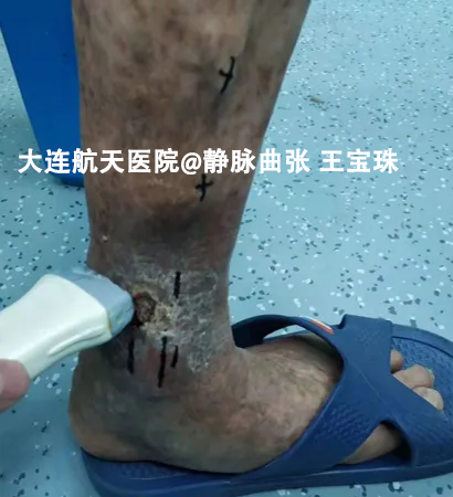 下肢静脉曲张（老烂腿）怎么办