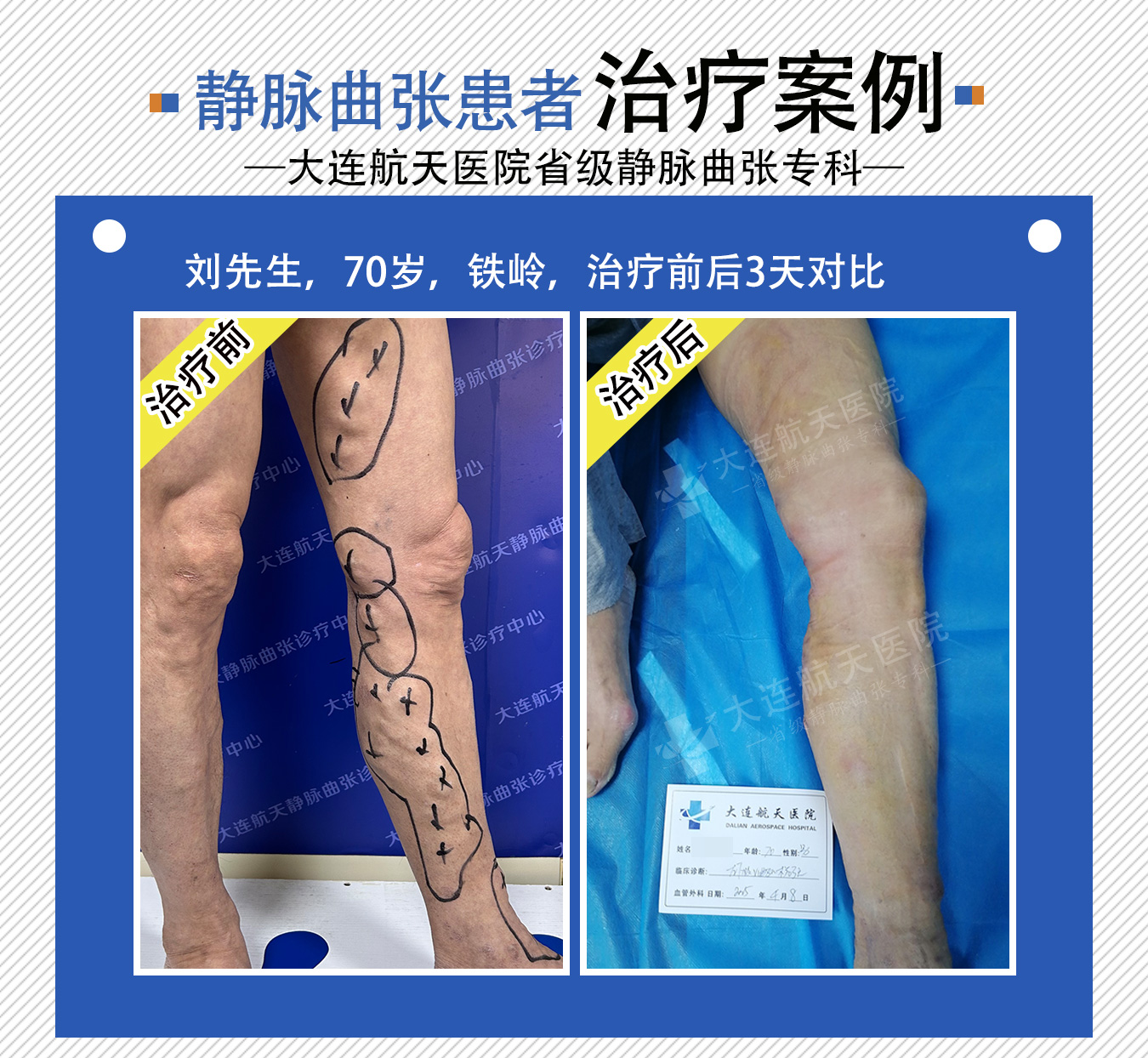 大连航天医院微创治疗静脉曲张好不好