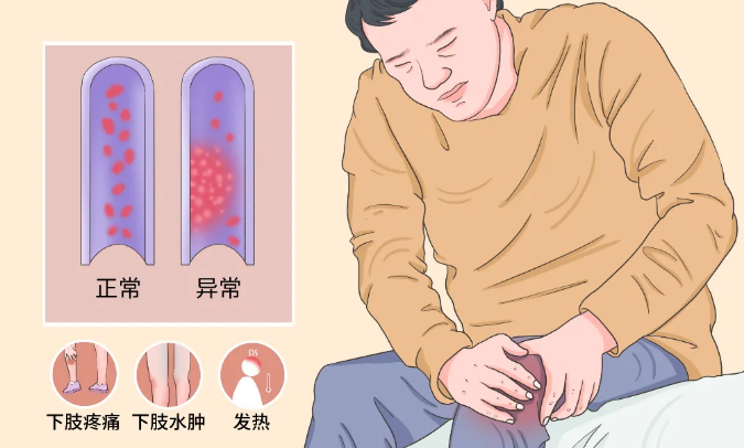 下肢深静脉血栓怎么办？