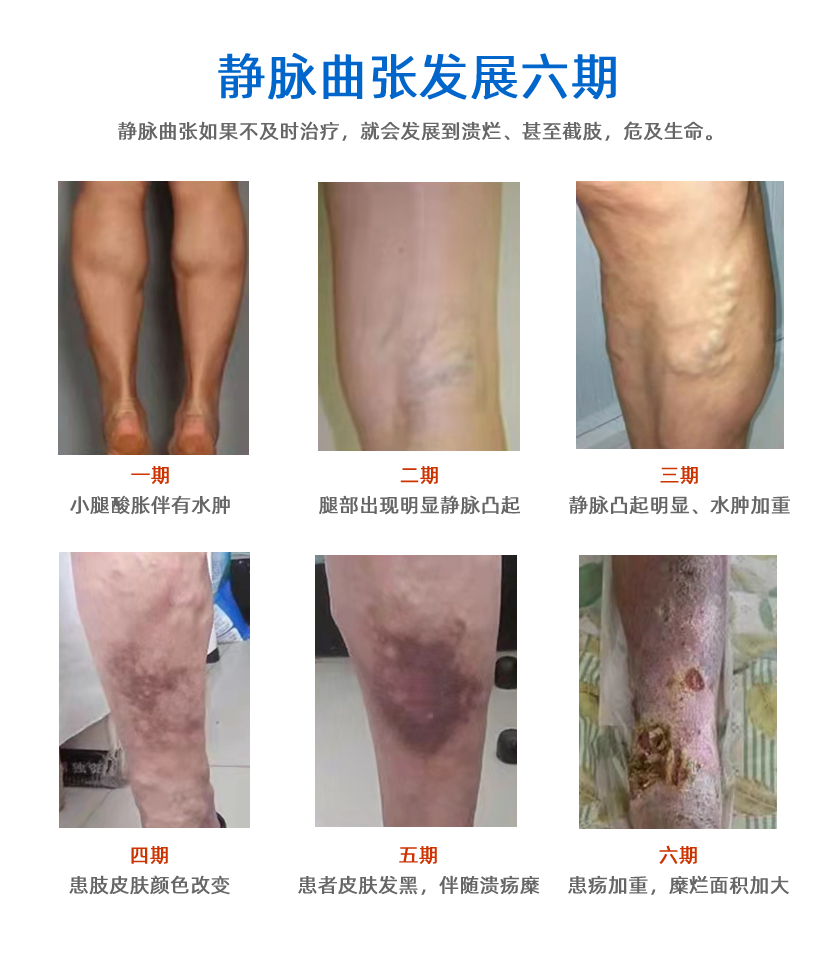 大连航天医院下肢静脉血栓：潜藏的健康威胁