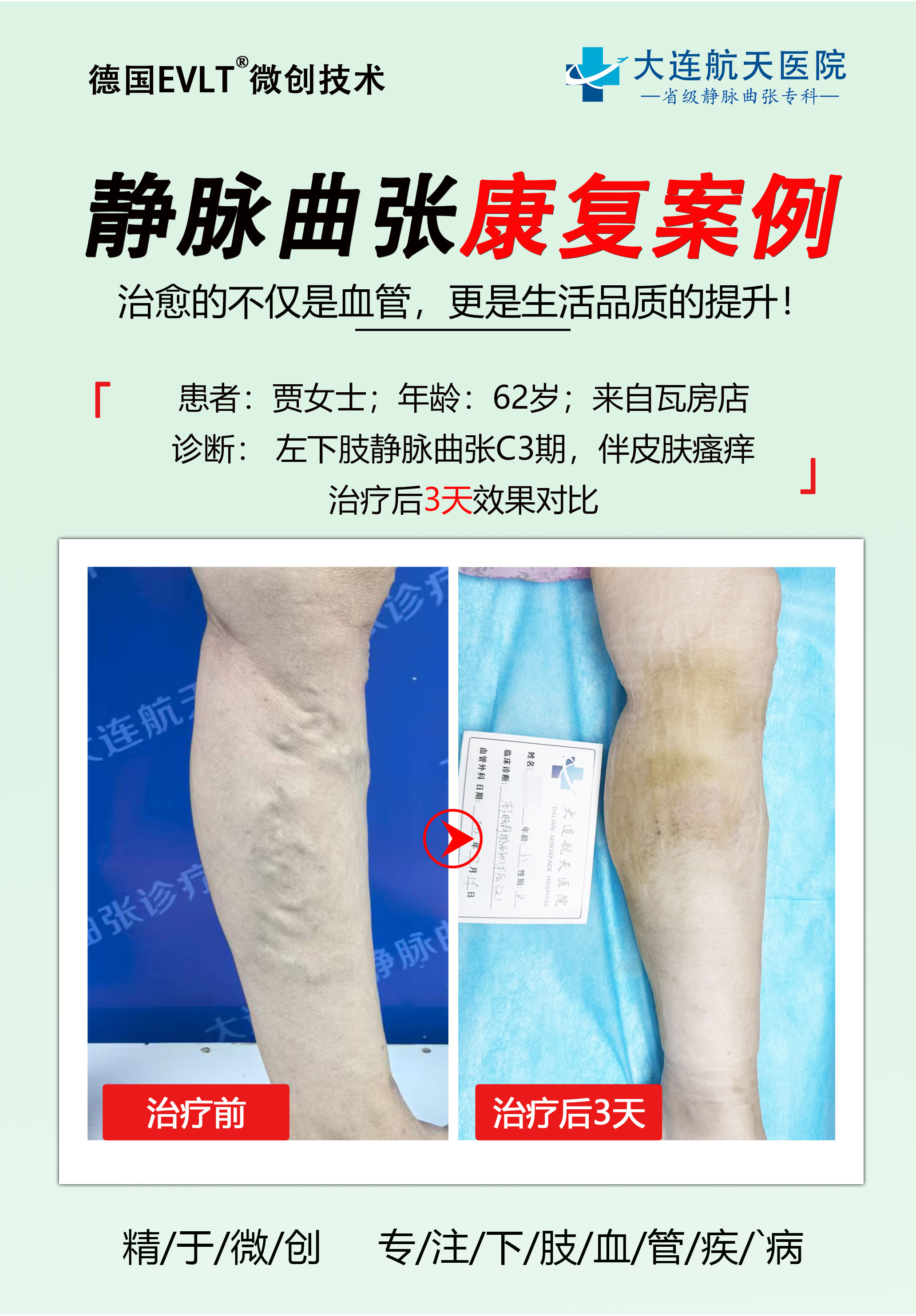 下肢静脉曲张：不可忽视的血管 “蚯蚓腿”