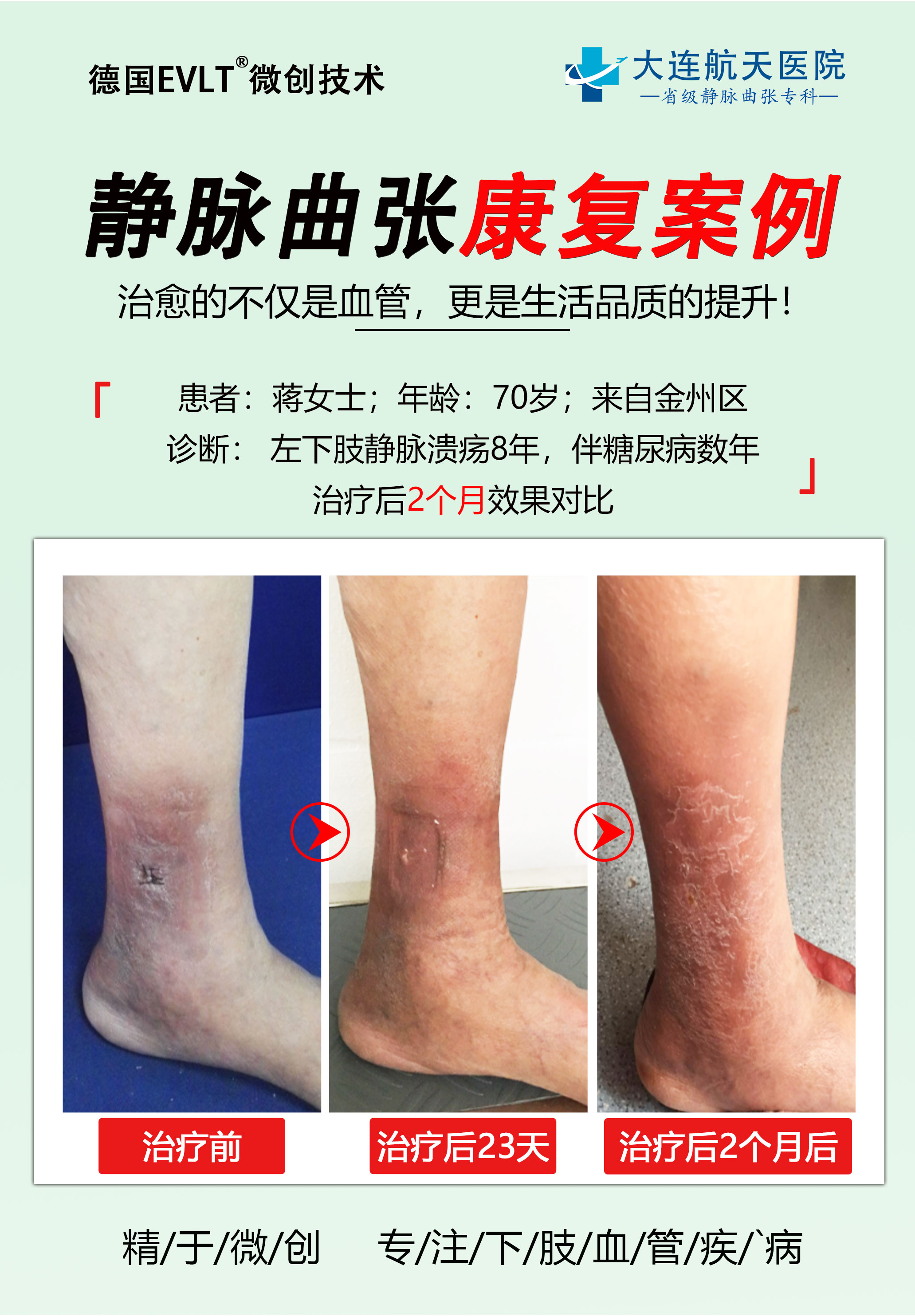 彭兴伟：下肢静脉曲张这5个危害不能小觑！