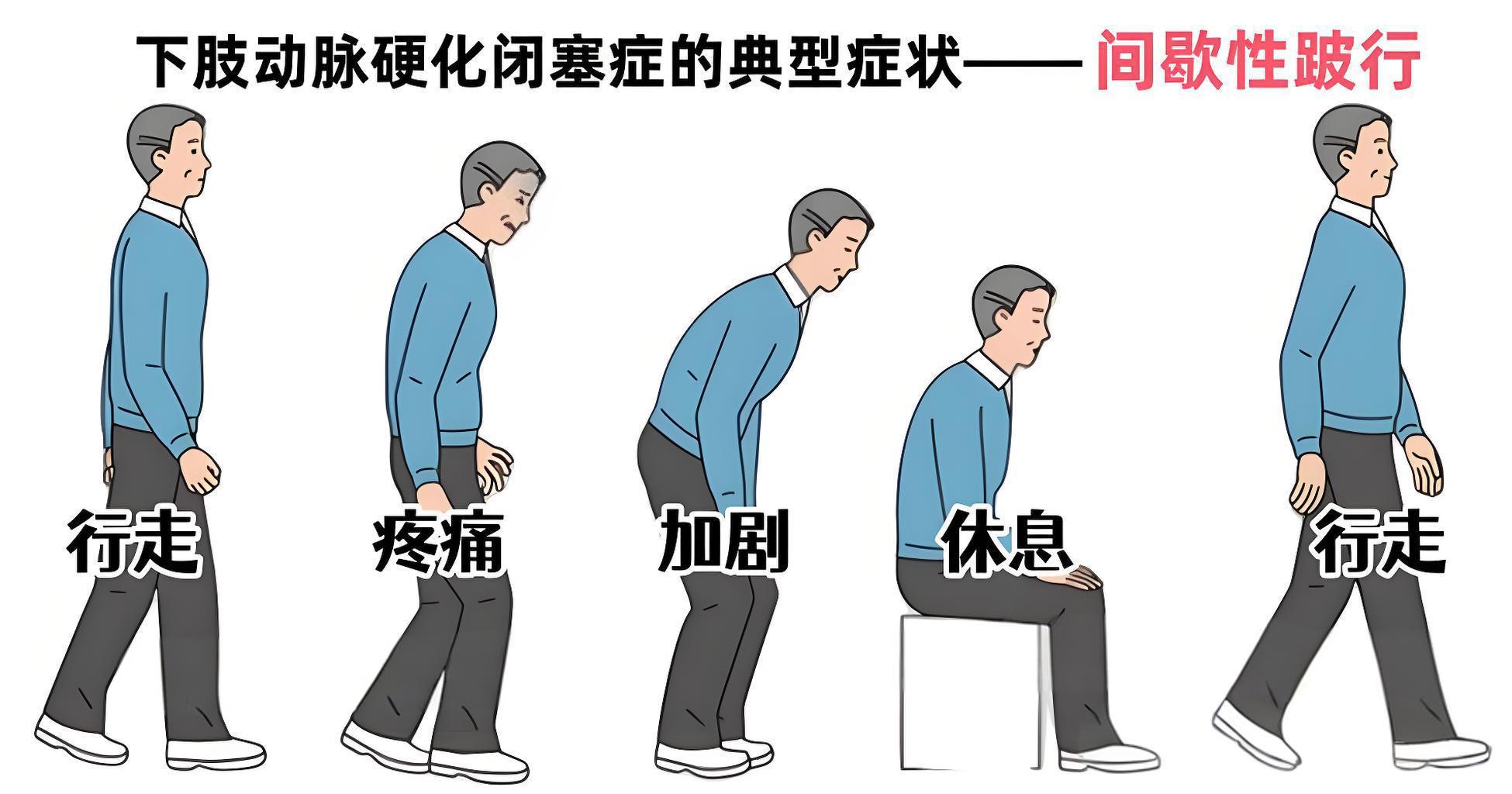  彭兴伟：下肢动脉硬化闭塞症的高发人群