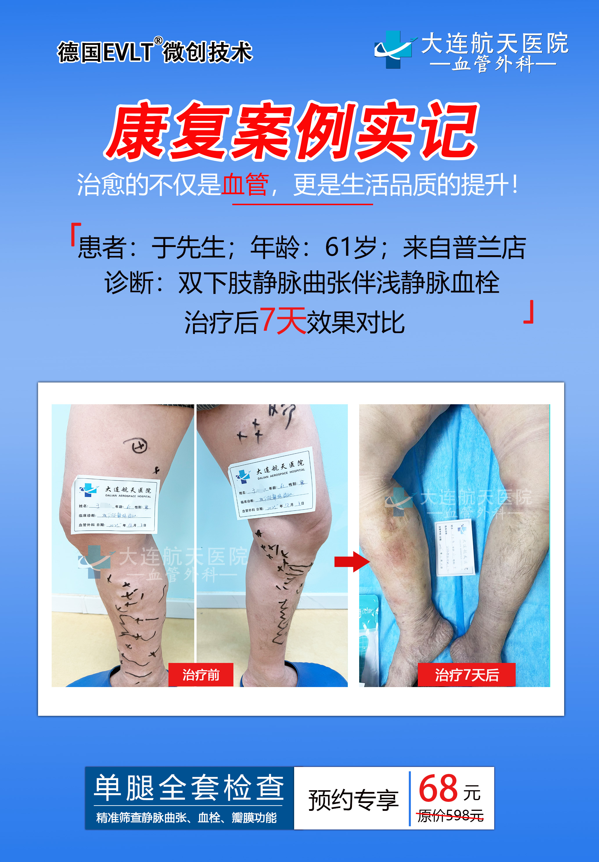 【大连航天医院】微创精准治疗下肢静脉曲张