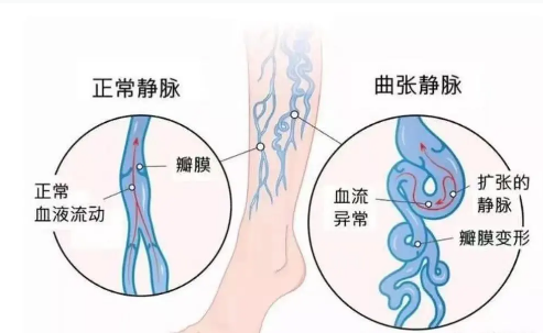大连航天医院专家解答:孕期为什么下肢静脉曲张高发？