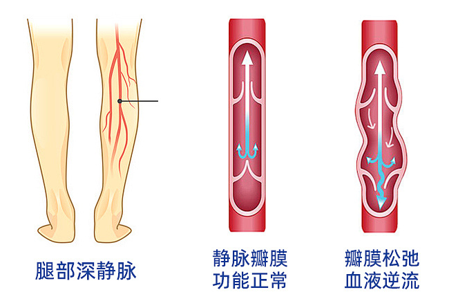 小腿静脉曲张该如何治疗？