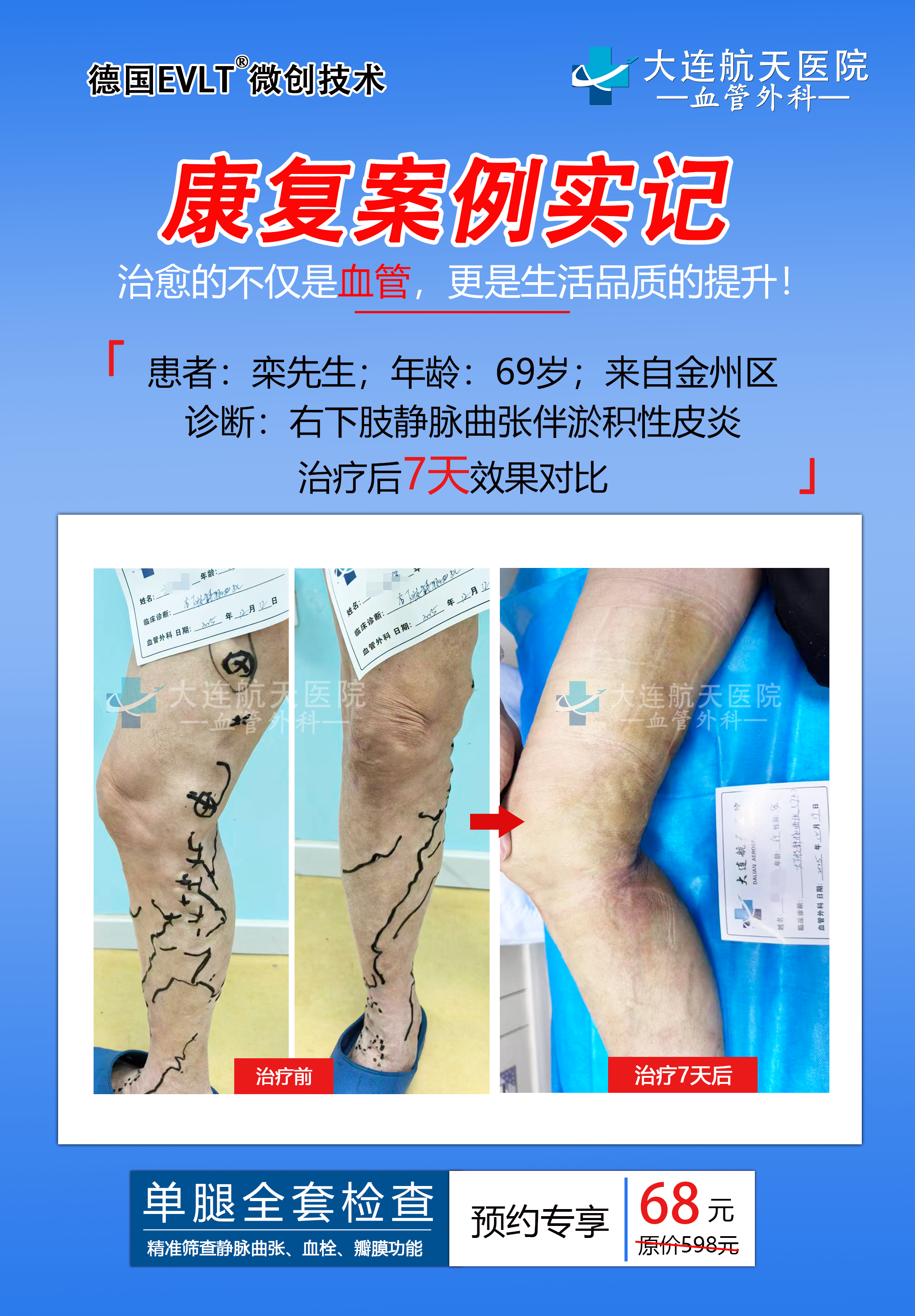 大连航天医院作静脉曲张手术费用多少？