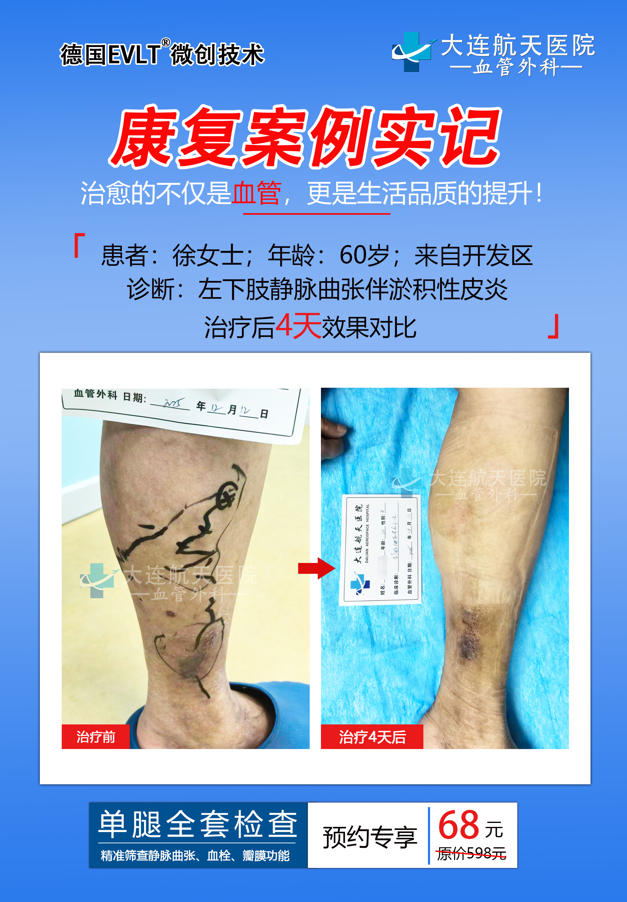 下肢静脉曲张最好的治疗方法#大连航天医院血管外科