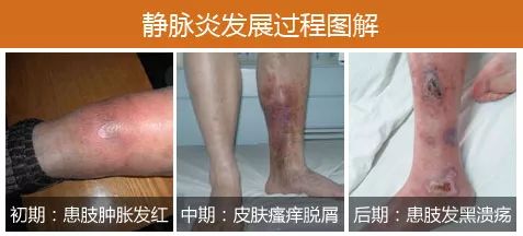 长在腿上的“蚯蚓”-静脉曲张 