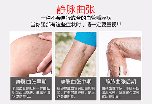 静脉曲张早期晚期中期.jpg