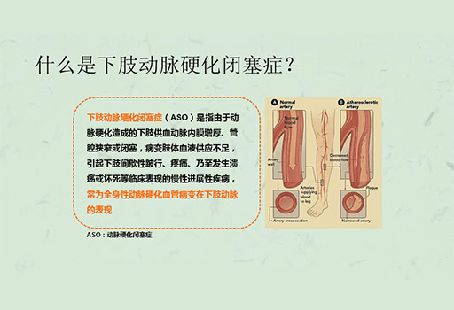 下肢动脉硬化闭塞症