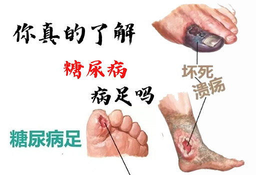 糖尿病引起的血管病主要表现是什么