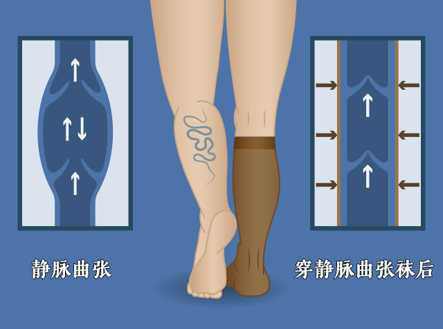 静脉曲张弹力袜，你穿对了吗？ 