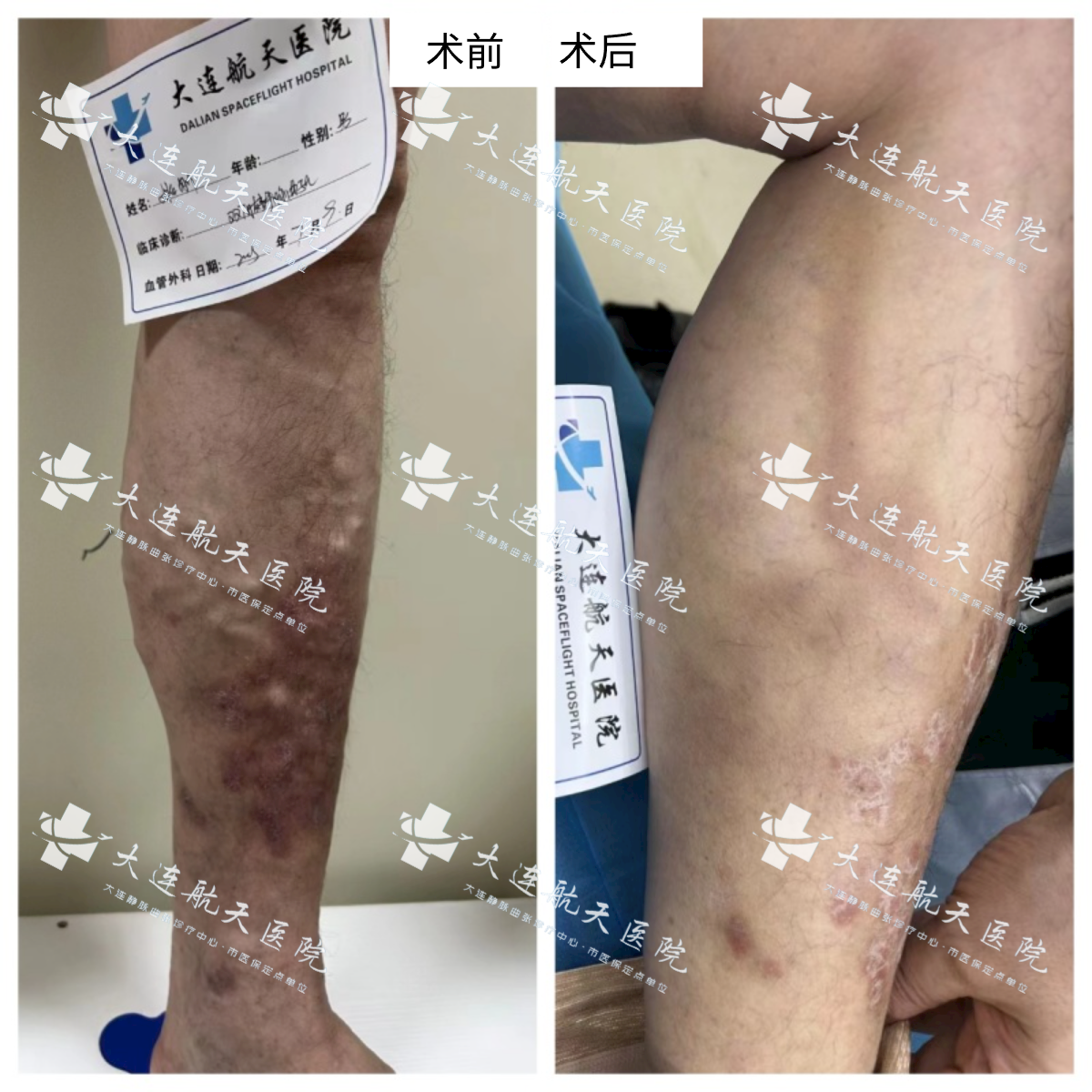 姚某 男 双下肢静脉曲张