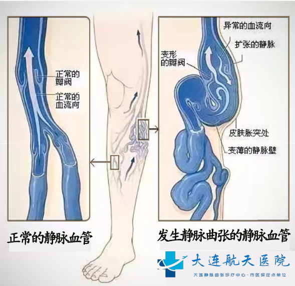 静脉曲张对比图320