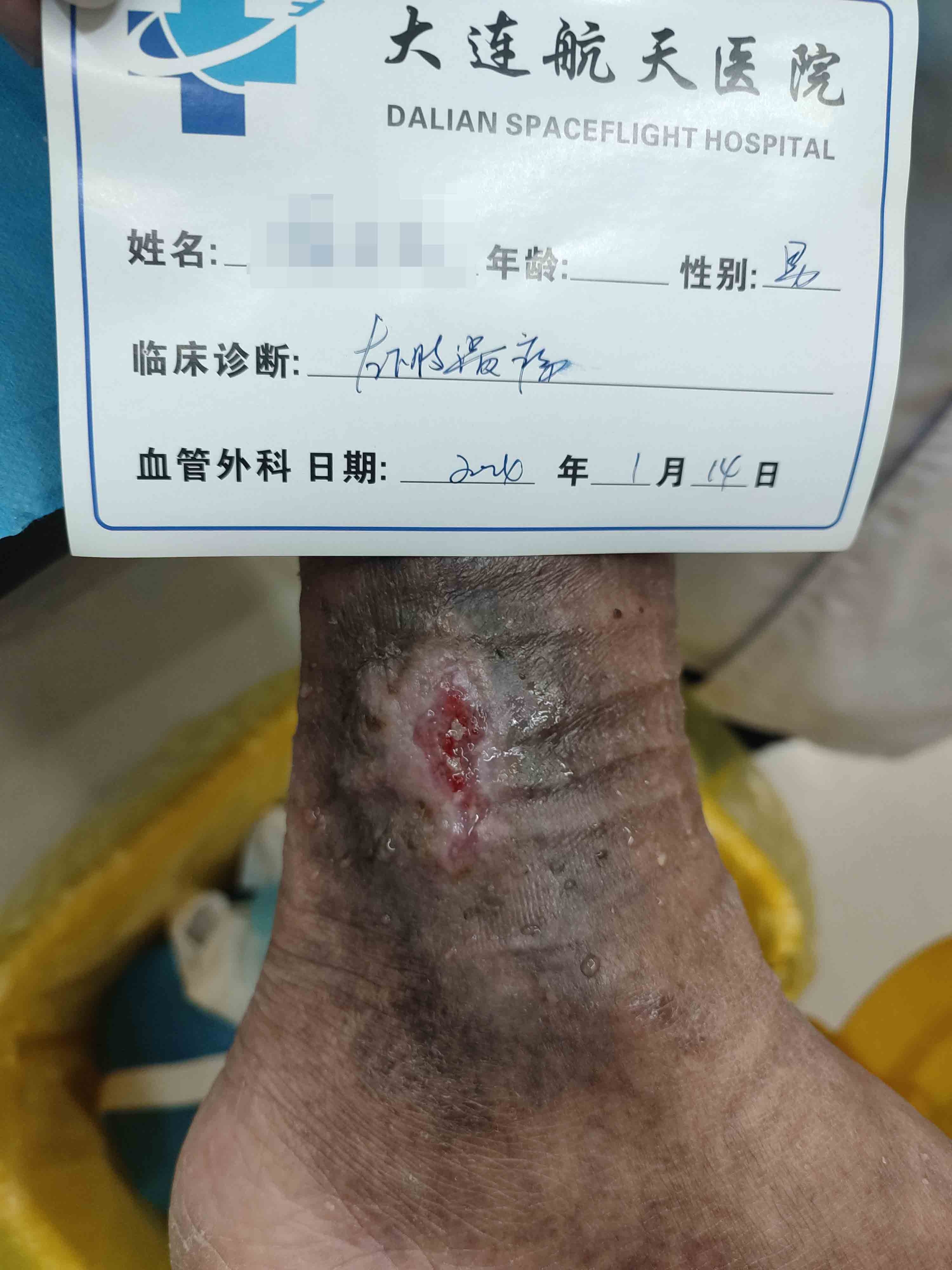 老烂腿