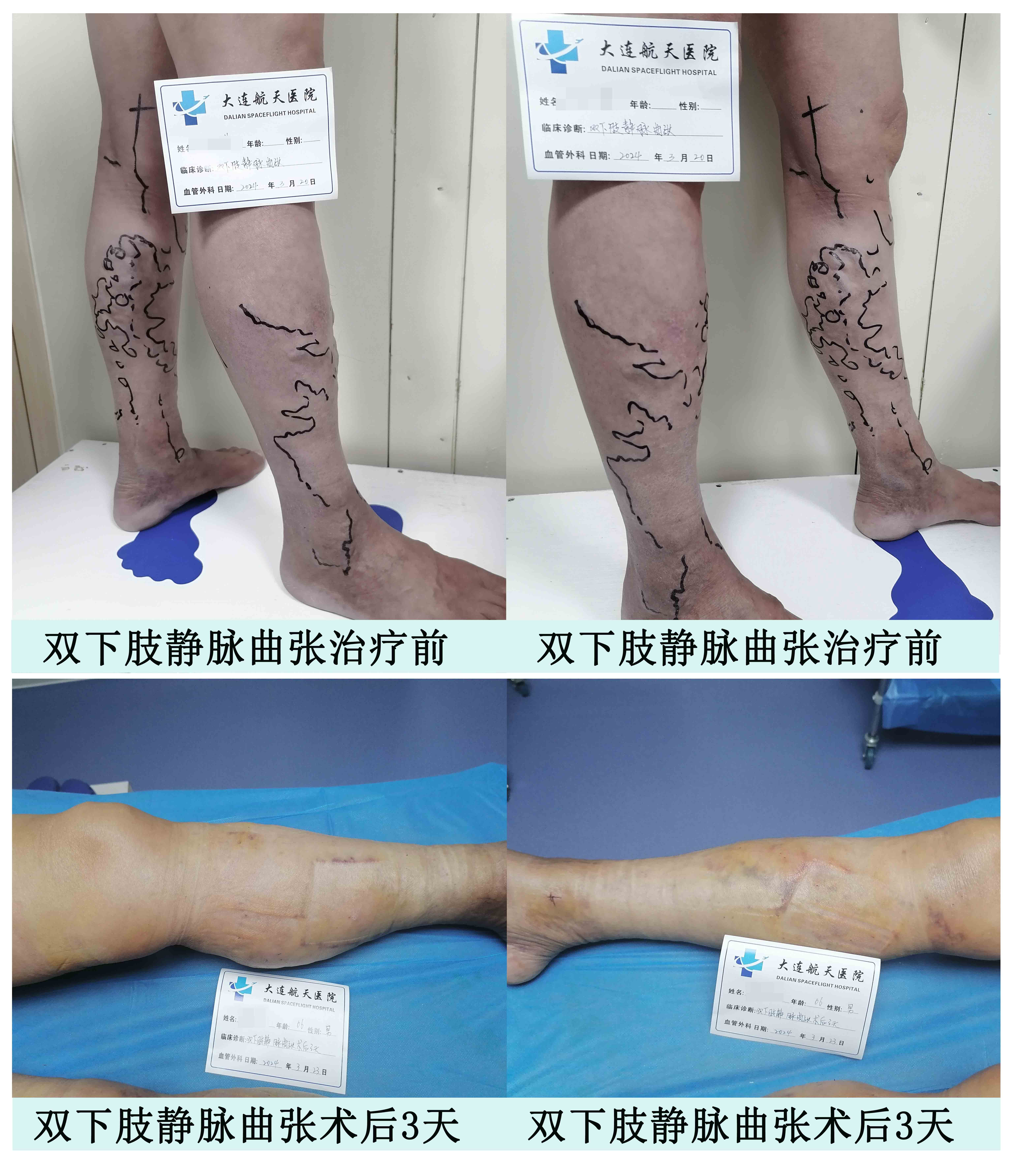 术后3天