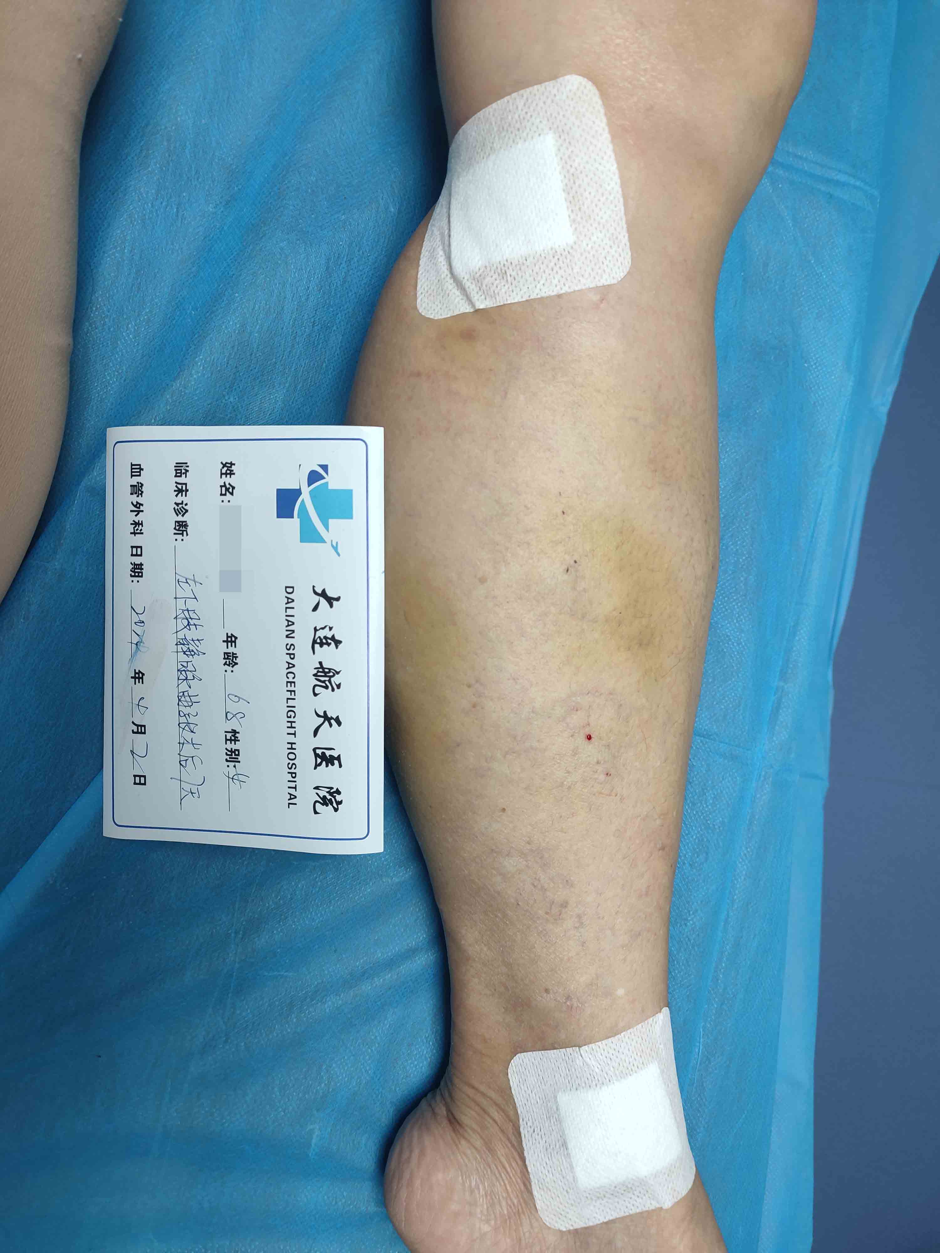 术后