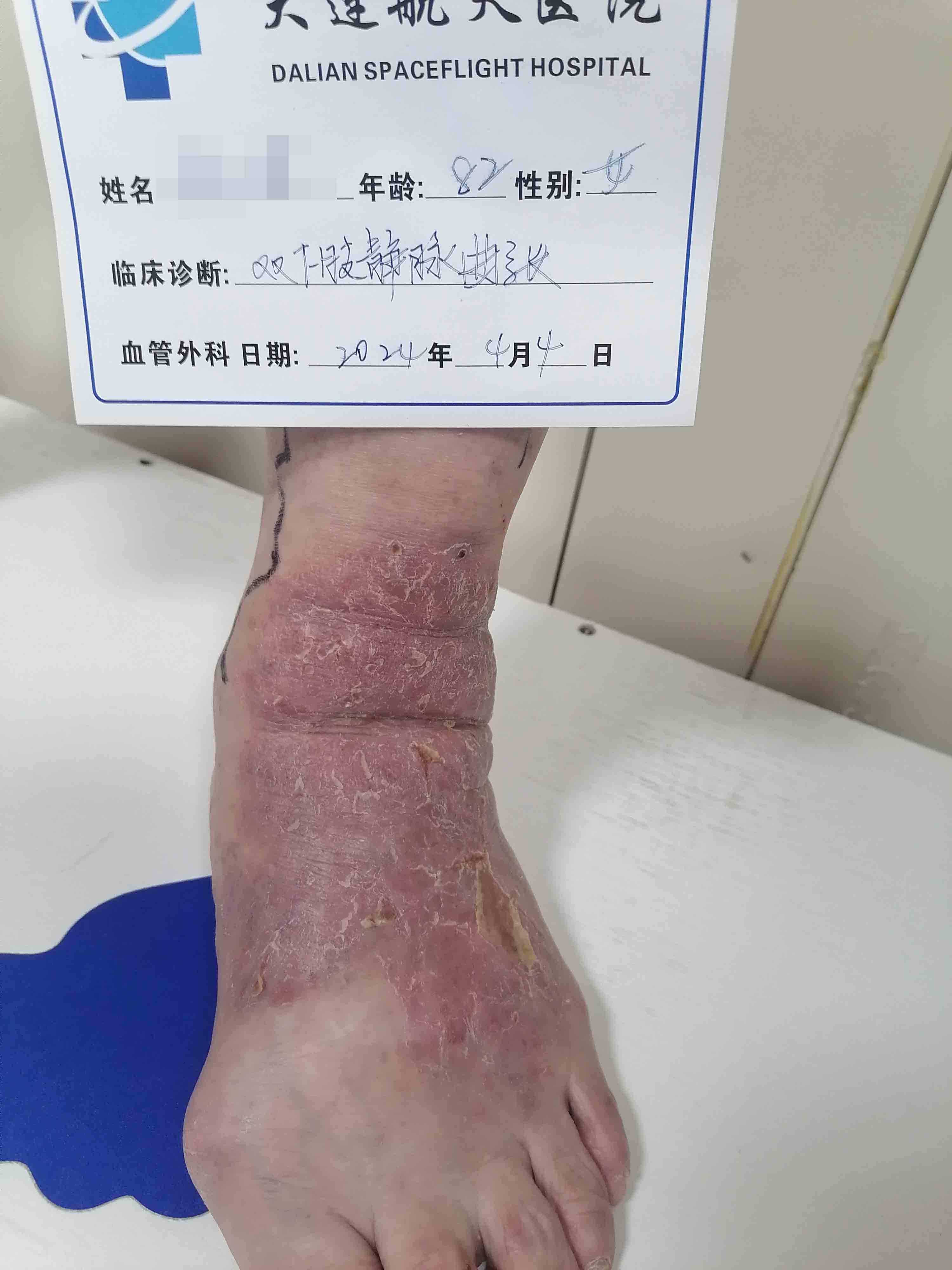 李永建术前脚烂2
