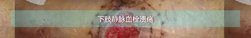 静脉血栓