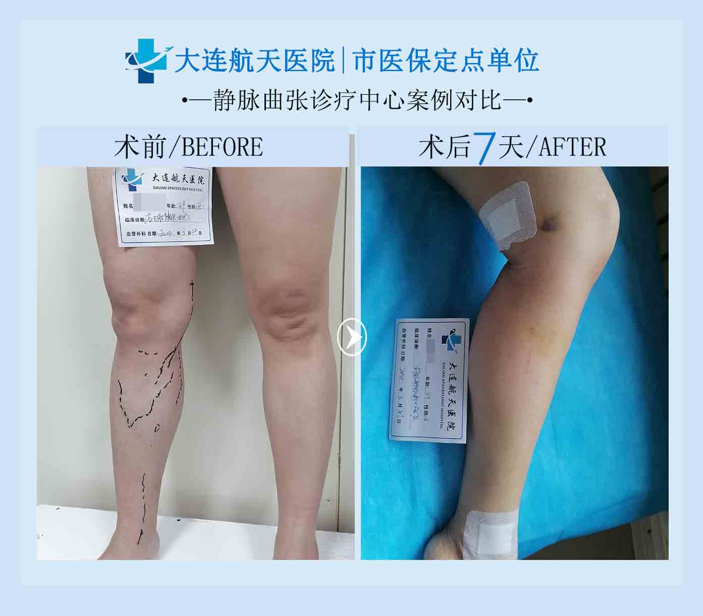 术后7天对比案例
