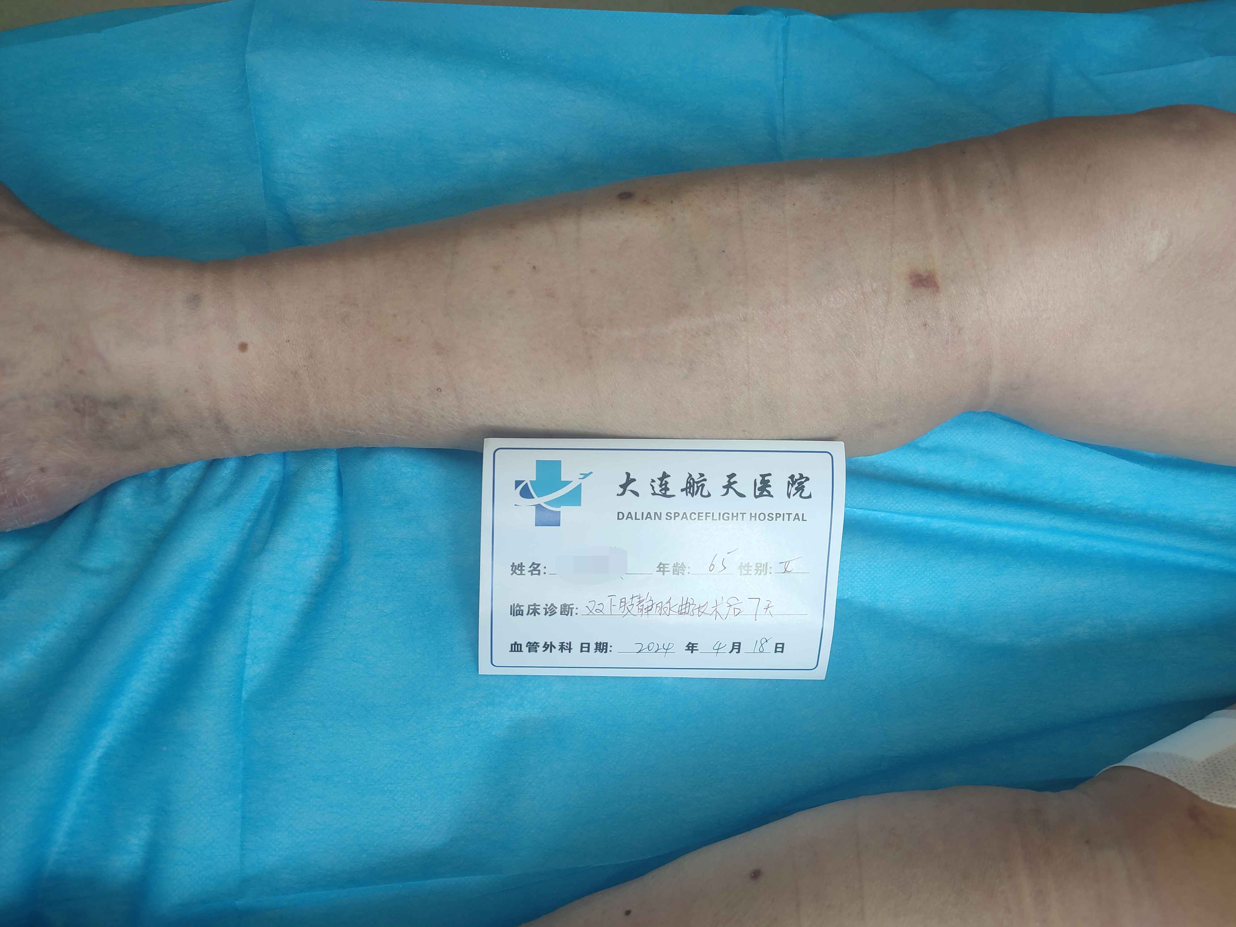术后7天
