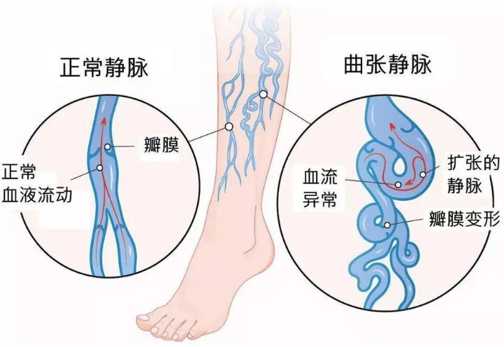 静脉曲张等级