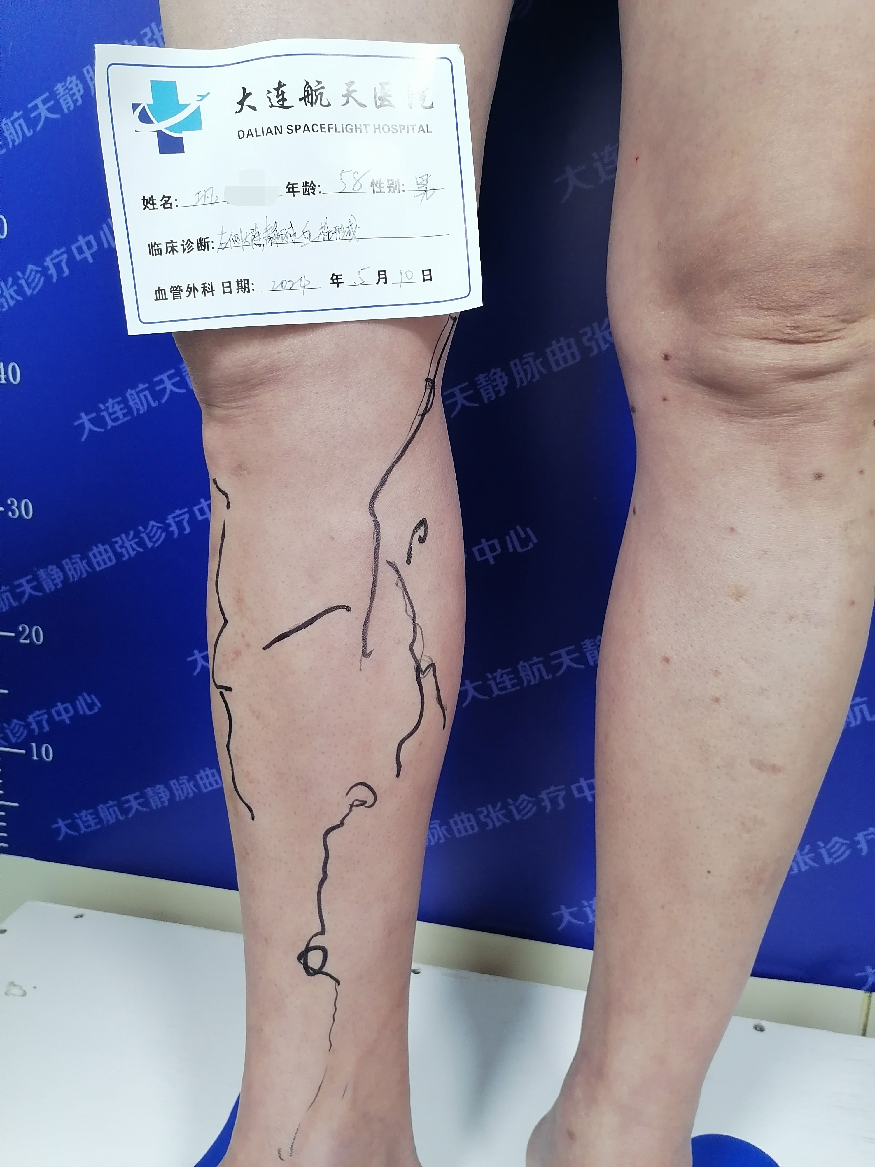 巩玉喜案例JPG