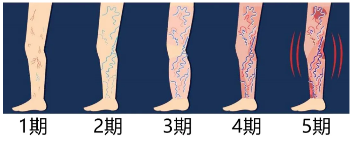 蚯蚓