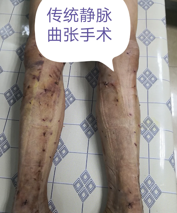 传统手术治疗