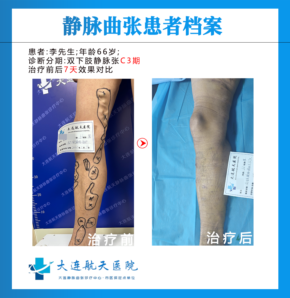 李铁强术后7天案例对比
