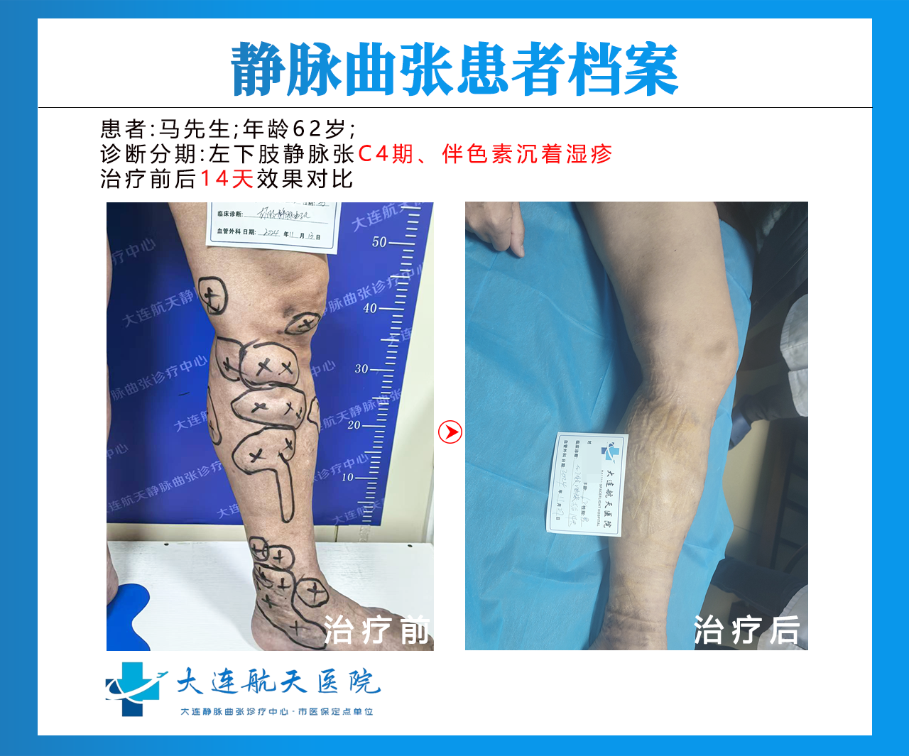 大连马立新术后14天对比