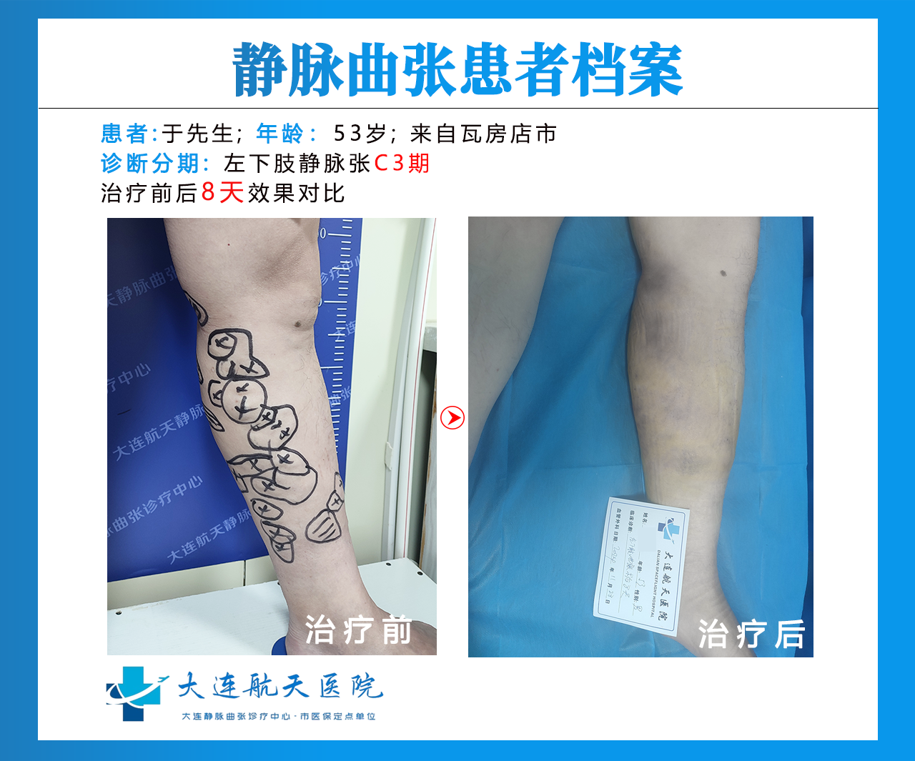 大连于有民术后8天案例对比