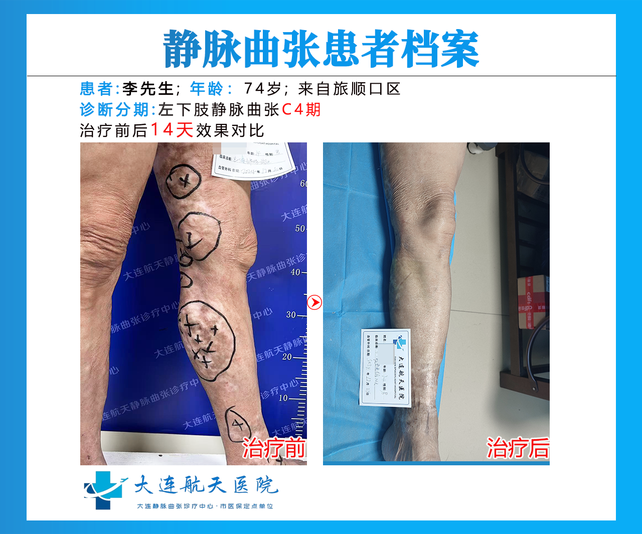 大连李克斌术后14天
