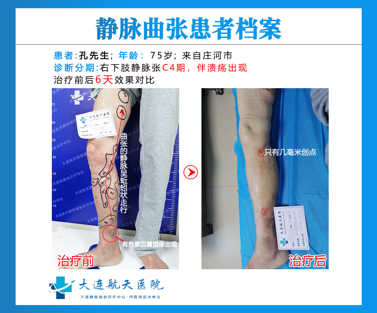 大连孙宪旭术后6天对比