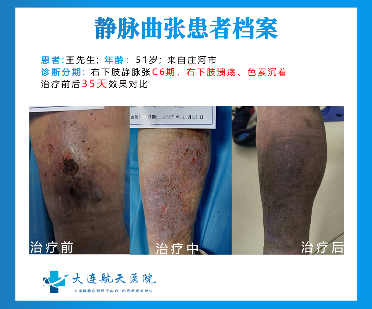 王永明大连老烂腿