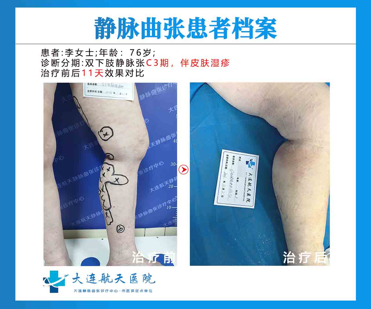 大连李秀芬术后11天对比