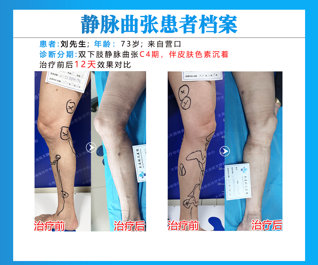 大连刘玉州术后12天对比