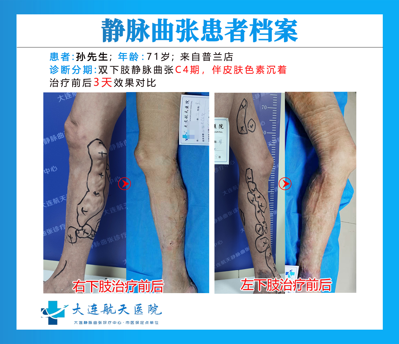 孙广政术后3天对比