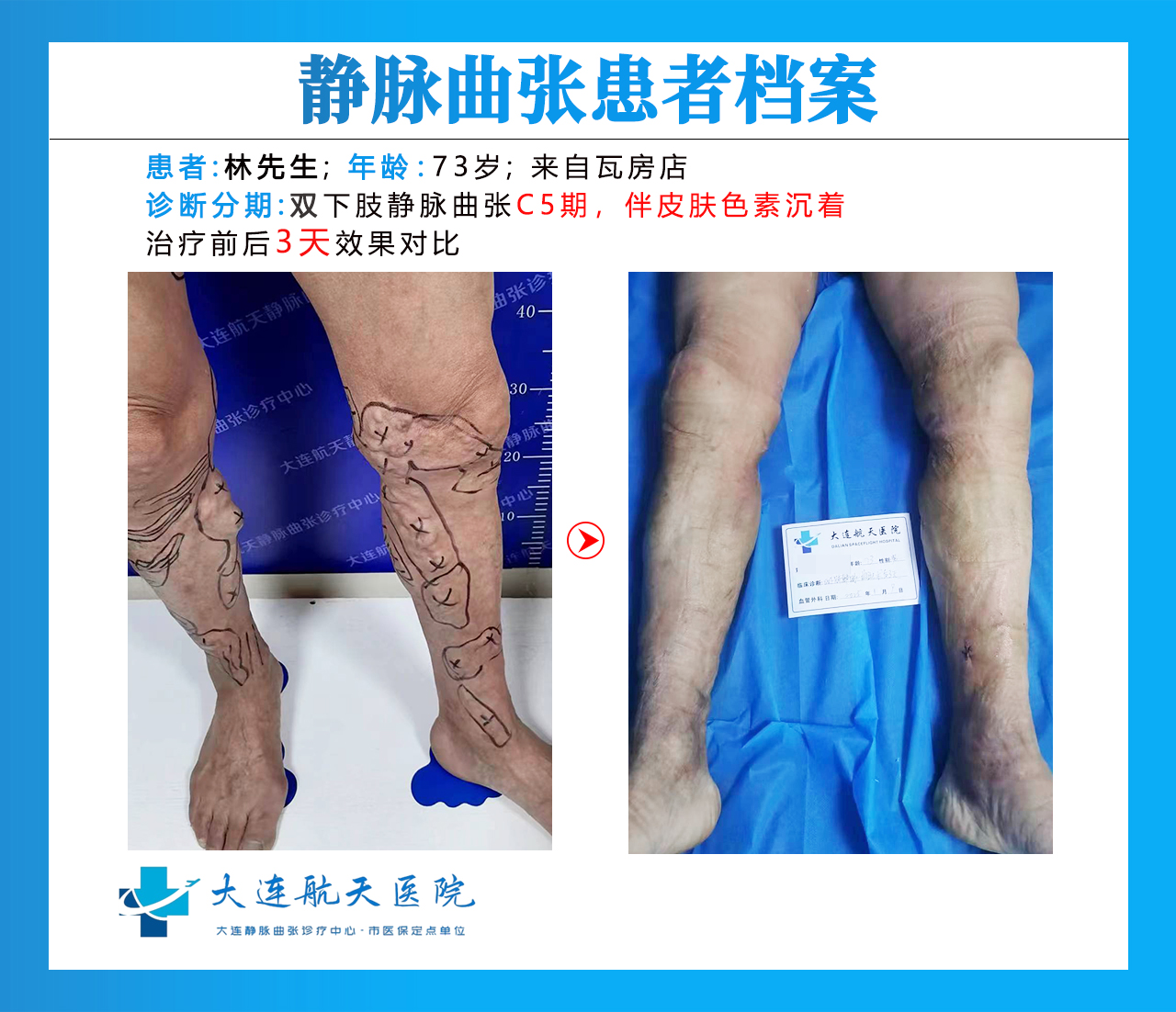 大连林学成术后3天对比