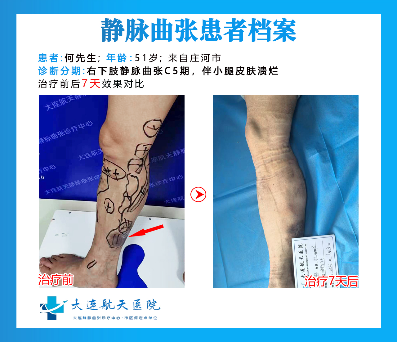 大连何云胜术后7天对比
