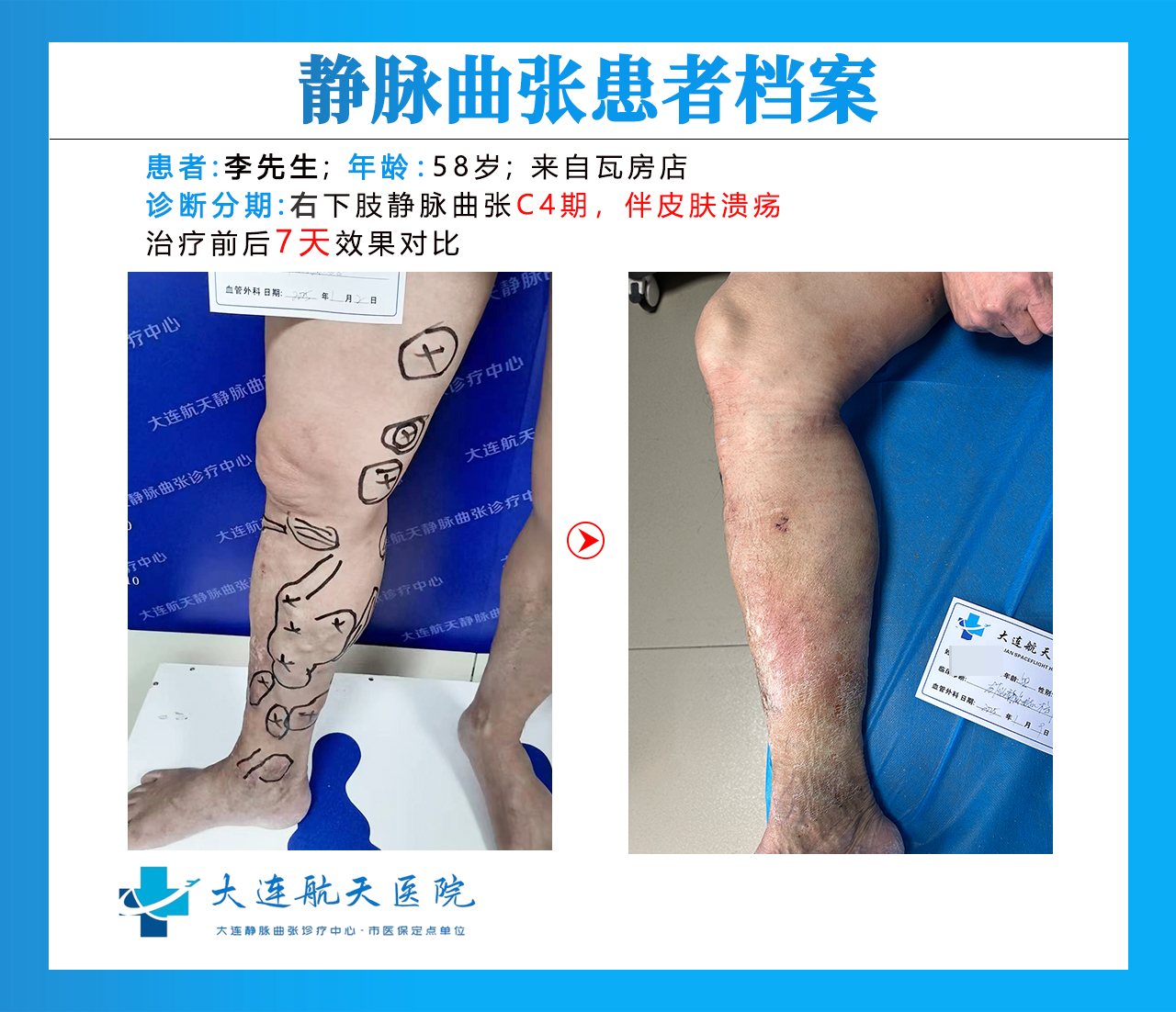 大连李春海术后7对比
