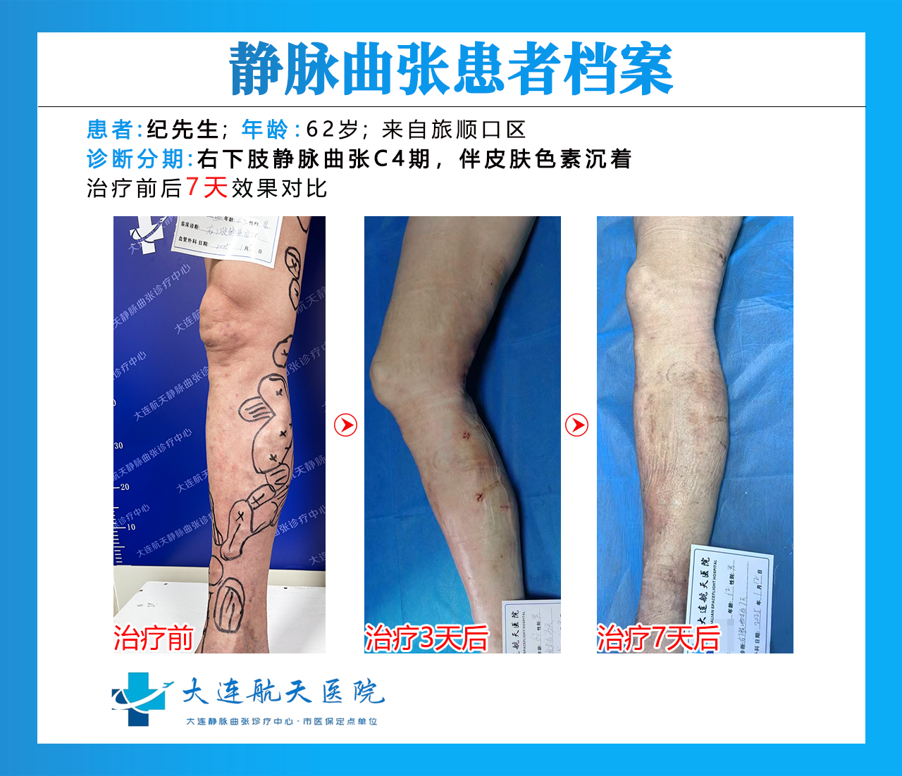 大连纪照盛术后7天效果对比