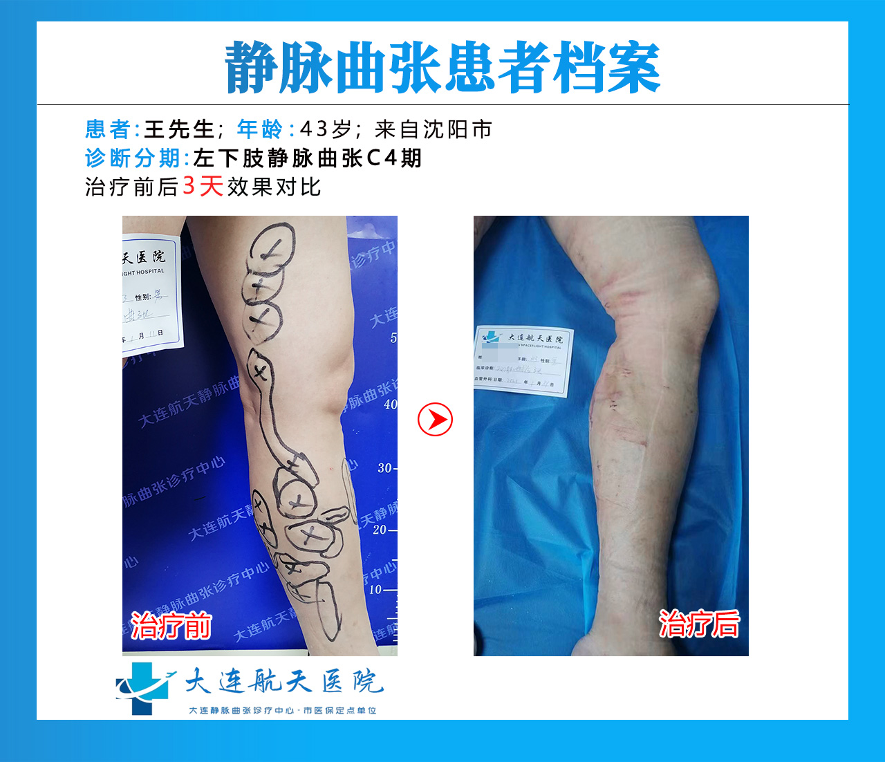 大连王学东术-后3天